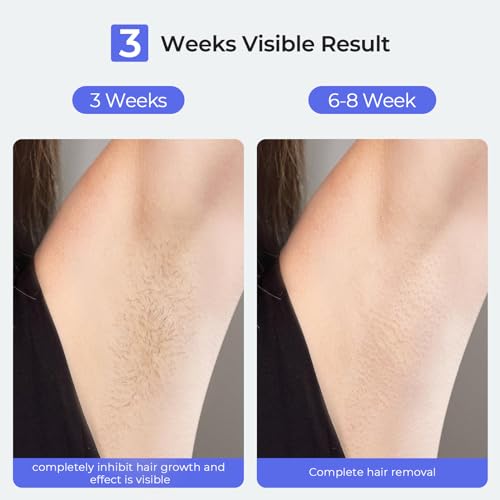IPL Laser Hair Removal Device S483